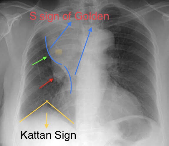 ➡️Classical CXR of Rt Upper Lobe collapse
1-Homogenous opacity Rt upper &amp; middle zones with a ‘S’ shaped lower border (Marked by green arrow) 
2- Another small opacity just below the medial part of S 
shaped border (Marked Red arrow)
3- Tenting of Right Hemidiaphragm.

1️⃣ Cont👇