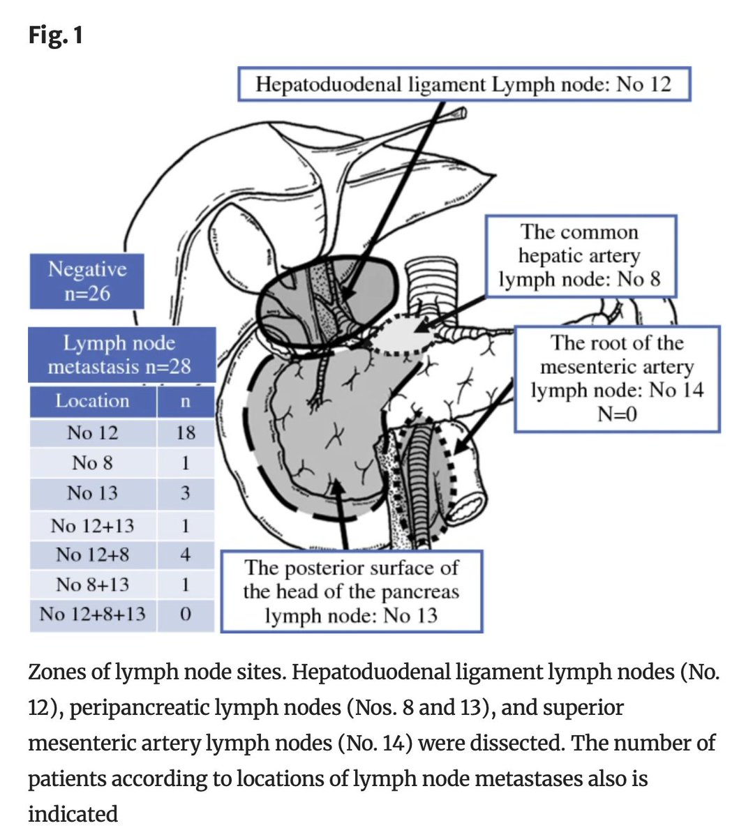 AnnSurgOncol's tweet photo. JANUARY ISSUE: The Short- and Long-Term Surgical Results of Consecutive #Hepatopancreaticoduodenectomy for Wide-Spread #BiliaryMalignancy.https://t.co/rszZz4VCrI @SocSurgOnc https://t.co/41tZIA2Kpr