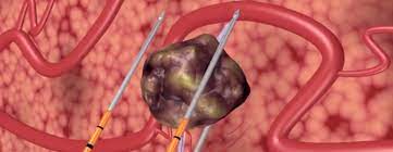 Irreversible #electroporation could be helpful in challenging liver #Metastasis in combination with #liversurgery <a href="/hospitaldelmar/">Hospital del Mar</a>
✅May preserve hepatic veins
✅Not affected by heat sink effect
✅Spares liver tissue
WDYT? <a href="/aecirujanos/">aecirujanos</a> <a href="/IHPBA/">IHPBA</a>  <a href="/SERAM_RX/">SERAM - Sociedad Española de Radiología Médica</a>