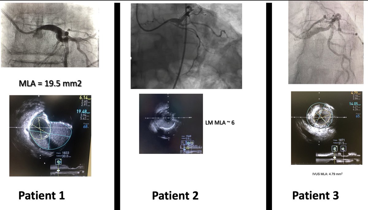 @BCMHeart @WKayaniMD @BaylorCardio @MusaSharkawiMD @ShariqShamimMD @jedicath @mmamas1973 @timir_paul @SCAI @SanChris999 @JingLiu_MD @SalikNazirMD @evandrofilhobr @Pooh_Velagapudi @KPujdak @Obisht @DrIHHashmi1 @HadyLichaaMD @ashaukat09 @TWilsonMD @jl35wilsonMD @DrBIqbal Here are #IVUS images matched w MLA of the 3 LMs. All 3 LMs w ~50% angiographic stenosis YET have a significant variability in IVUS MLAs Teaching pt for #ACCFIT : Always IVUS when ANY doubt for LM, coz difference could be CABG versus nothing! #CardioTwitter #Cardiology