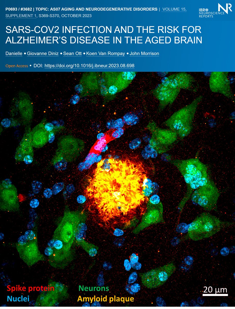 Is #COVID19 a risk factor for Alzheimer's disease? Most primates naturally develop senile plaques (beta-amyloid protein deposits), one of the misfolded proteins known to accumulate in the brain in normal aging and Alzheimer's Disease. Since monkeys can also catch #SARSCoV2 and…