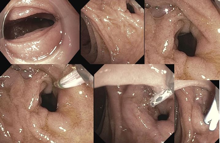 Ganesh Aswath MD (@ganeshaswathmd) on Twitter photo Played an hour of "find the papilla" in a redundant duodenum to discover it was hidden in a small tic, terrible position of course ๐คท๐ฝโโ๏ธ Exciting but not fun at 6 PM!
<a href="/Dr_VishnuKumar/">Vishnu Kumar</a> <a href="/MuzaffarAkbar/">Hafiz Muzaffar Akbar Khan</a> <a href="/UpstateGastro/">Upstate Gastroenterology</a> <a href="/KelitaSingh/">Kelita Singh</a> Played an hour of "find the papilla" in a redundant duodenum to discover it was hidden in a small tic, terrible position of course ๐คท๐ฝโโ๏ธ Exciting but not fun at 6 PM!
<a href="/Dr_VishnuKumar/">Vishnu Kumar</a> <a href="/MuzaffarAkbar/">Hafiz Muzaffar Akbar Khan</a> <a href="/UpstateGastro/">Upstate Gastroenterology</a> <a href="/KelitaSingh/">Kelita Singh</a>