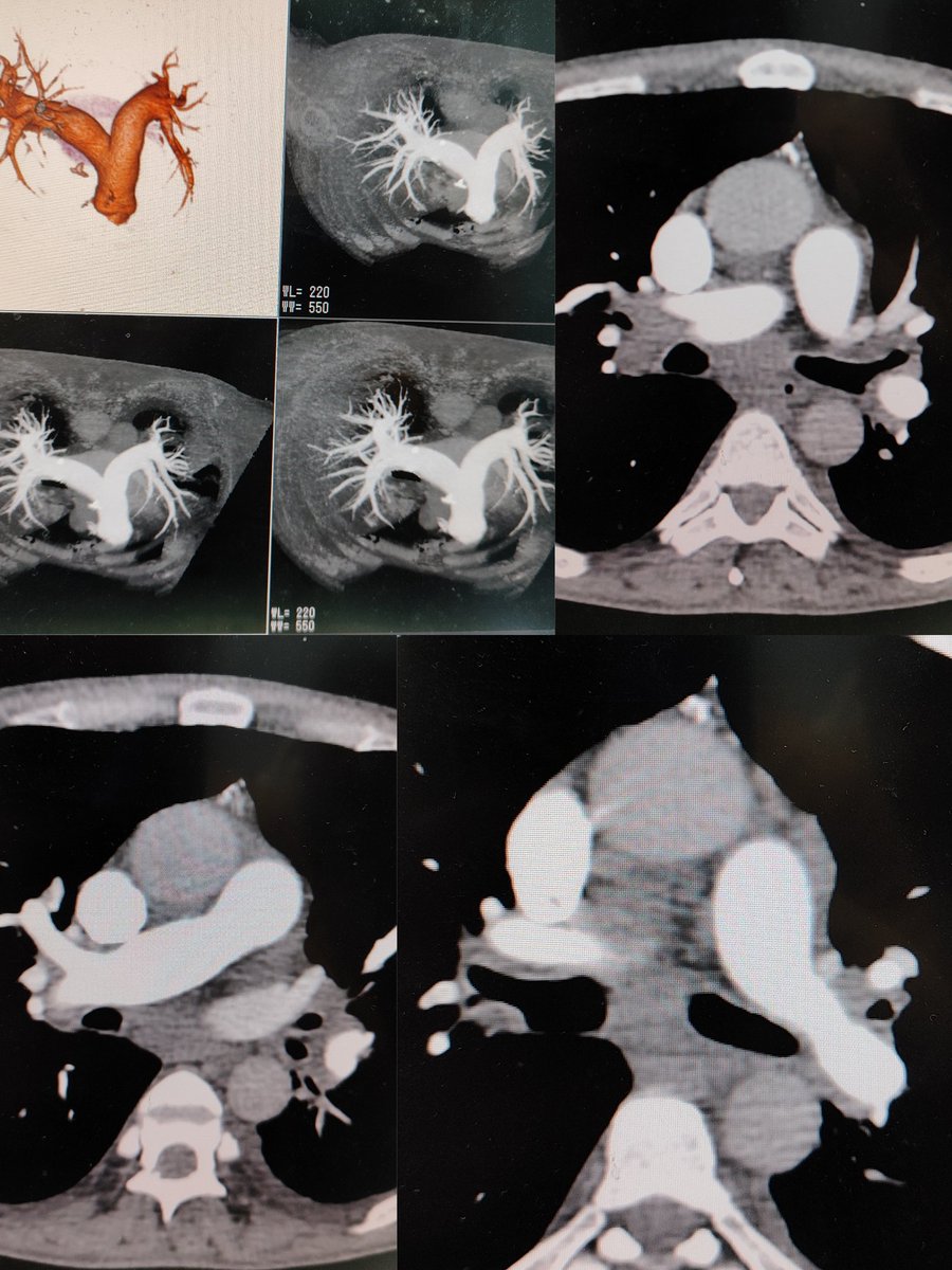 Pulmonary Angiography♥️