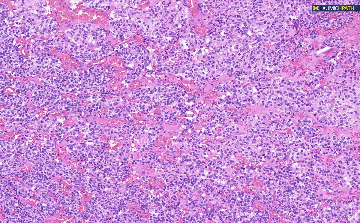 Michigan Pathology (@umichpath) on Twitter photo 🔬Check out the #COTW from <a href="/sarahnfarran/">Sarah Farran, MD, MPH</a>!
A 37-year-old female has a 4.7 cm left frontal mass. Resection shows the lesion below. What is the molecular genetic hallmark of these tumors? 🔬Check out the #COTW from <a href="/sarahnfarran/">Sarah Farran, MD, MPH</a>!
A 37-year-old female has a 4.7 cm left frontal mass. Resection shows the lesion below. What is the molecular genetic hallmark of these tumors?