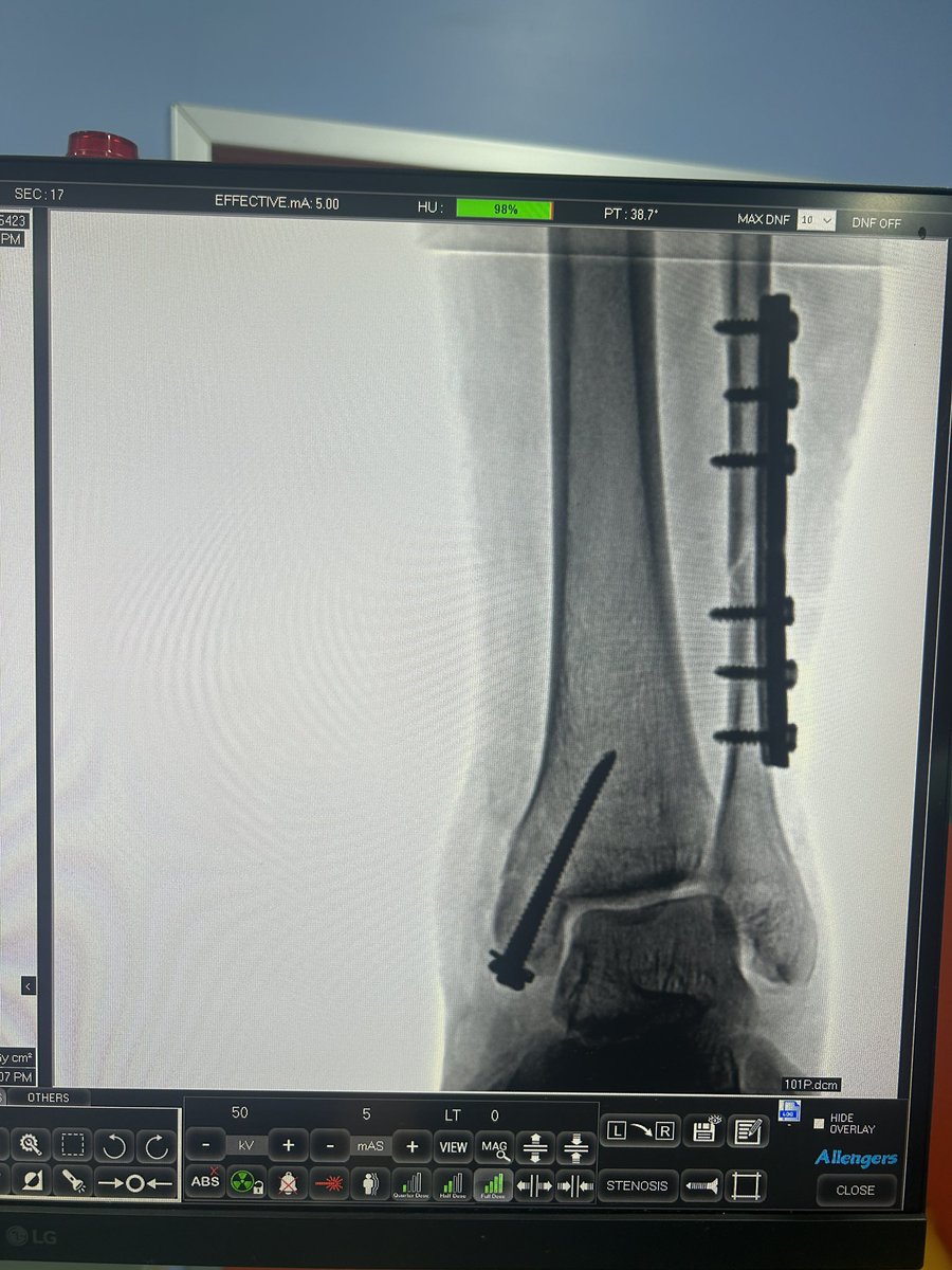 DrDardi's tweet photo. Ortho 1 
28-12-2023
1-Distal fibula plating with malleolar screw fixation 
2- Short PFN for intertroch # https://t.co/mTPLQBDSE4