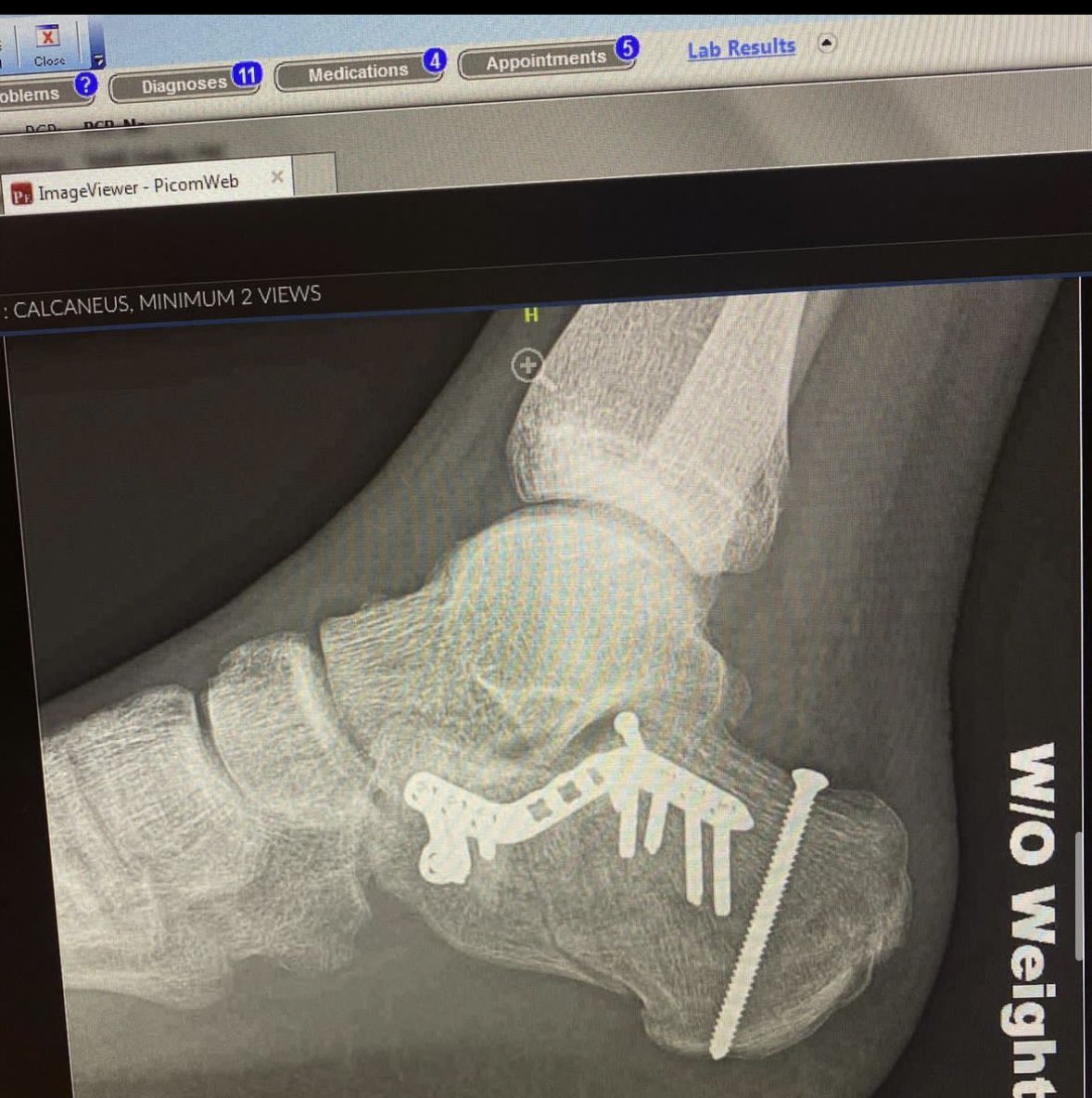 MrFullsend's tweet photo. Shattering both my heels was pretty neat. Not recommended though https://t.co/B917KSMVOk