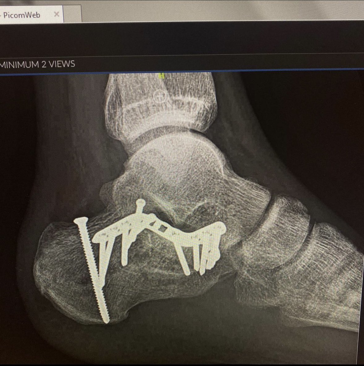 Shattering both my heels was pretty neat. Not recommended though