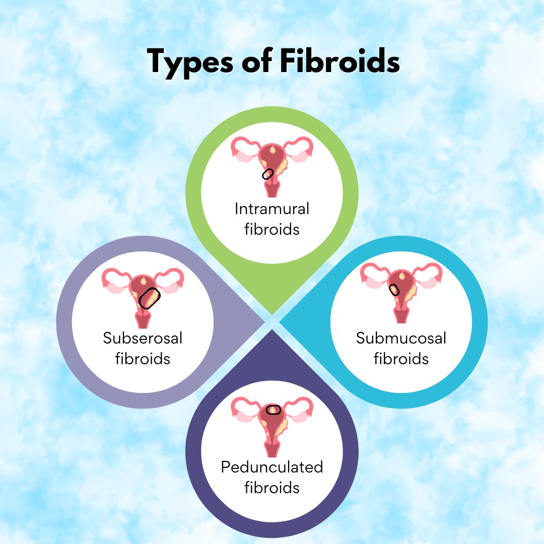 Ever wondered what the difference is between fibroid types? There's Subserosal, Intramural, Submucosal, and Pedunculated, each with its own spot in the uterus. #FibroidTypes #WomensHealth #FibroidAwareness Safety info: bit.ly/2LFfyHh