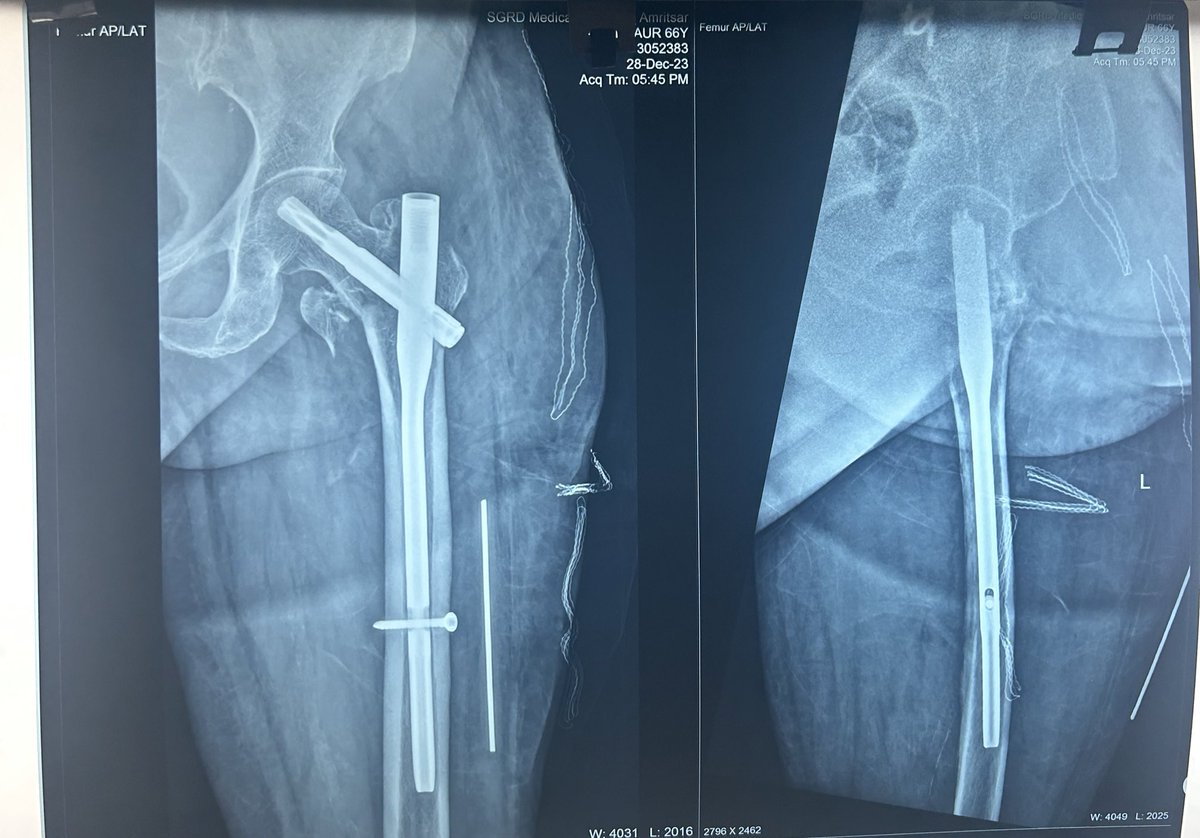 DrDardi's tweet photo. Ortho 1 
28-12-2023
1-Distal fibula plating with malleolar screw fixation 
2- Short PFN for intertroch # https://t.co/mTPLQBDSE4