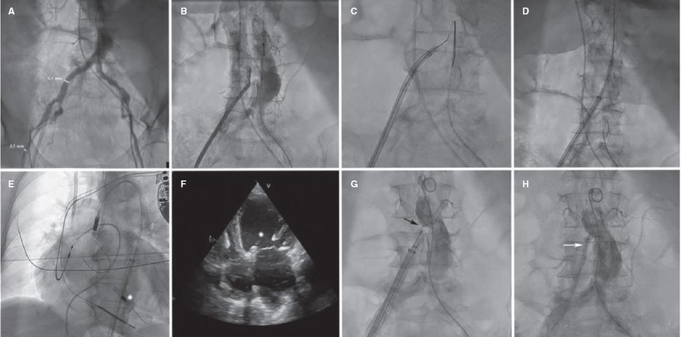 Ya disponible nuestra experiencia en #Impella y #ECMO con acceso transcava en pacientes con #shock cardiogénico en #recintervcardiol ! @RevEspCardiol  @Abiomed @semicyuc @vallhebron @ECMOHUVH @cardiologiavh 
Os invito a ver los videos 👇
acortar.link/mpD10O