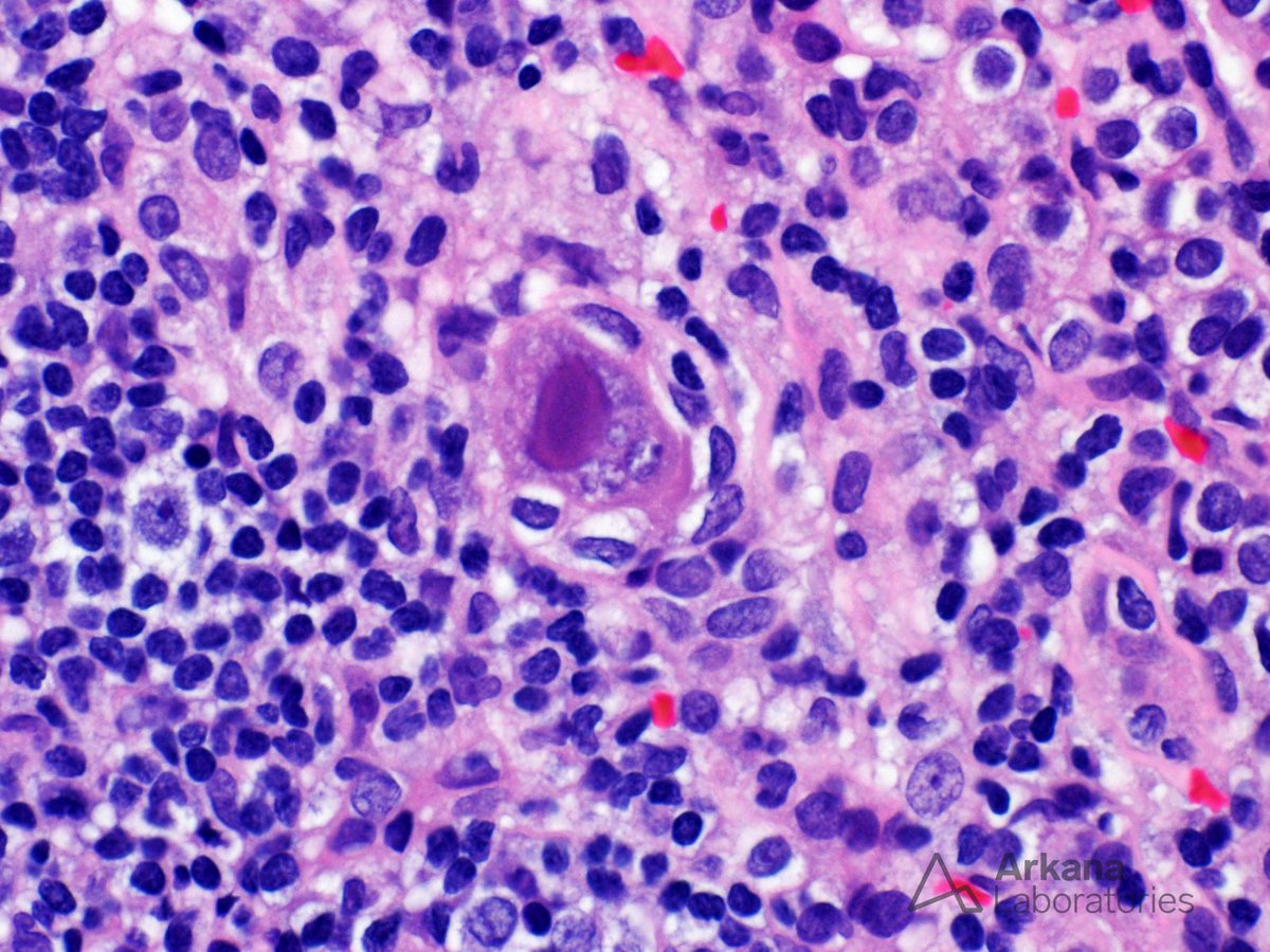 The biopsy from this adult kidney transplant recipient shows features of cytomegalovirus (CMV) infection, including prominent enlargement (“cytomegalo-”) of tubular epithelial cells and their nuclei, along with small basophilic inclusions which expand the cell cytoplasm.  An…