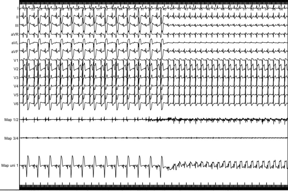 DrV_Mann's tweet photo. Last (urgent) ablation of the year 2023 @EP_Bremen, no. 2710 ! Great effort of the whole Team!

20yo male, LVEF<20%, >40% burden of PVC, Couplets, Triplets, nsVT, NYHA III-IV

🤞🏻for recovery!

@AGEP_DGK @ChristianHeeger @DavidDuncker @MuellerLeisse @C_Meyer_MD @Mel_Gunawardene https://t.co/C9T0Yhjk1u