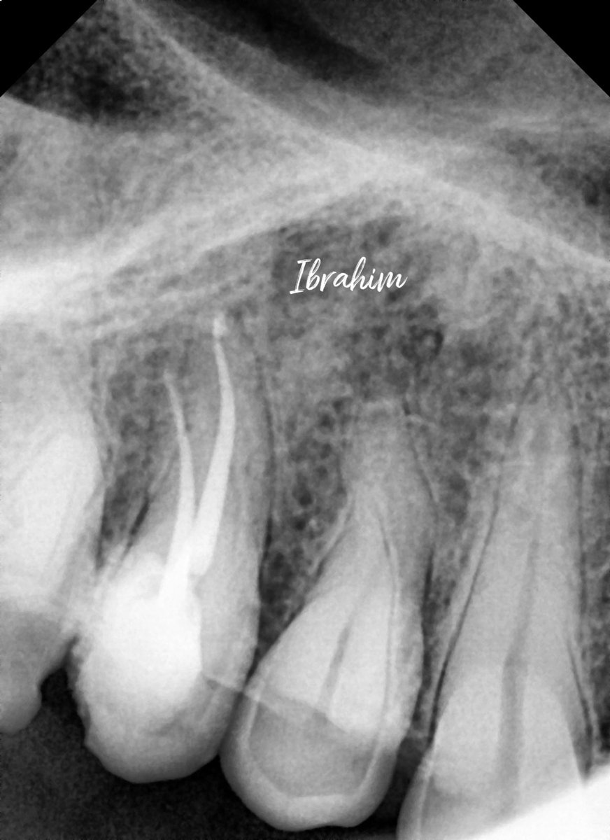 Dx: # 15 Necrotic pulp / Chronic apical abscess 

Tx: RCT

#الخميس_الونيس