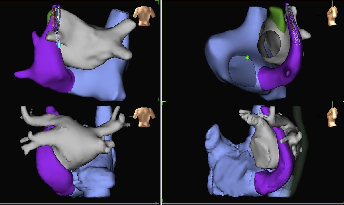 George Crowell (@georgecrowell) on Twitter photo Unwrapping the rare present of a persistent left superior vena cava (PLSVC) in cardiac anatomy.
#PDXmapping <a href="/sanghaimd/">Saket Sanghai MD FACC FHRS</a> Unwrapping the rare present of a persistent left superior vena cava (PLSVC) in cardiac anatomy.
#PDXmapping <a href="/sanghaimd/">Saket Sanghai MD FACC FHRS</a>