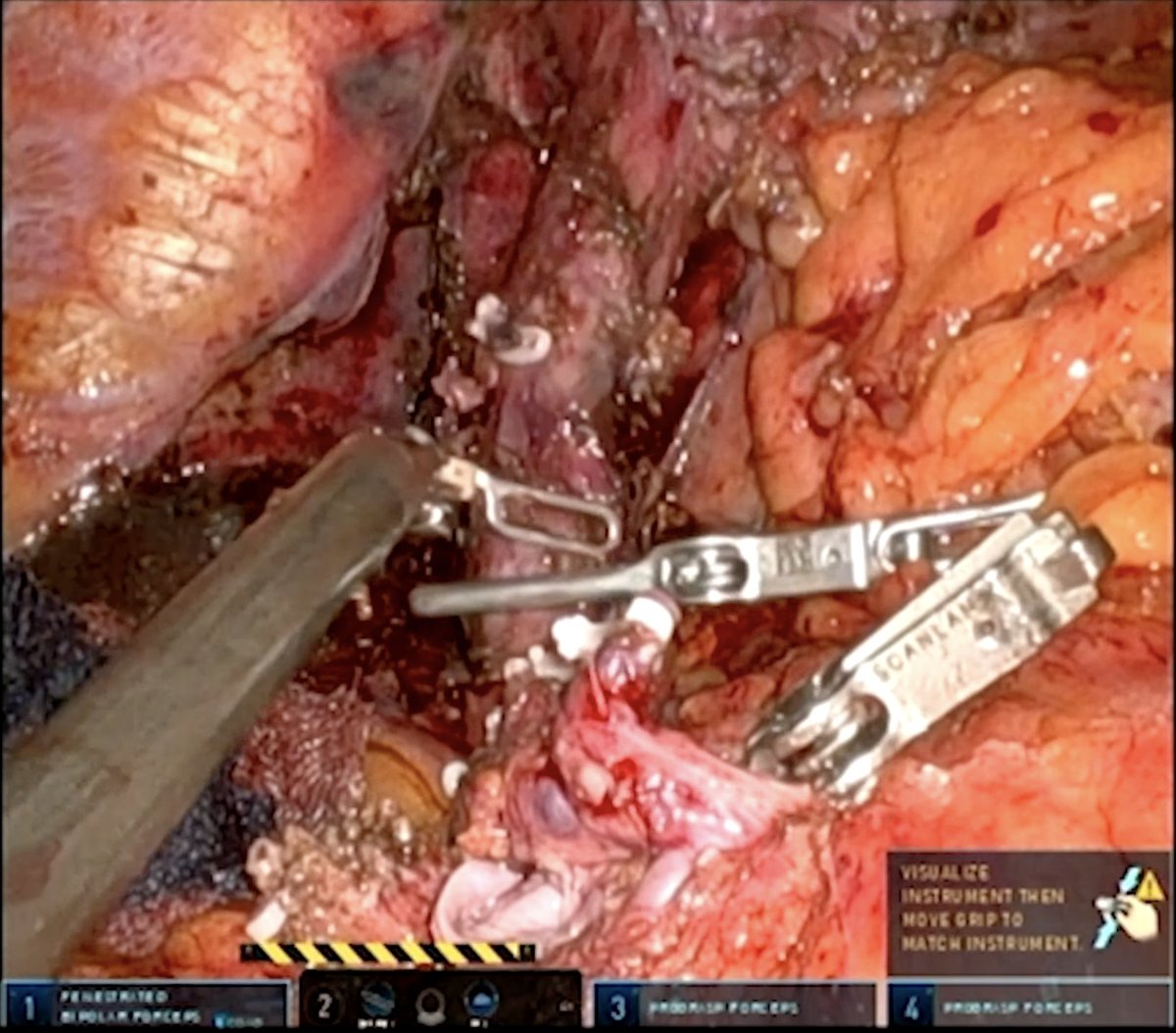 Embracing a "robotic-preferred approach" in 2022 significantly changed our division's practice of liver surgery and transplantation during 2023, expanding MIS benefits to complex hepatectomies, donor hepatectomies, and hepatectomy during transplantation.