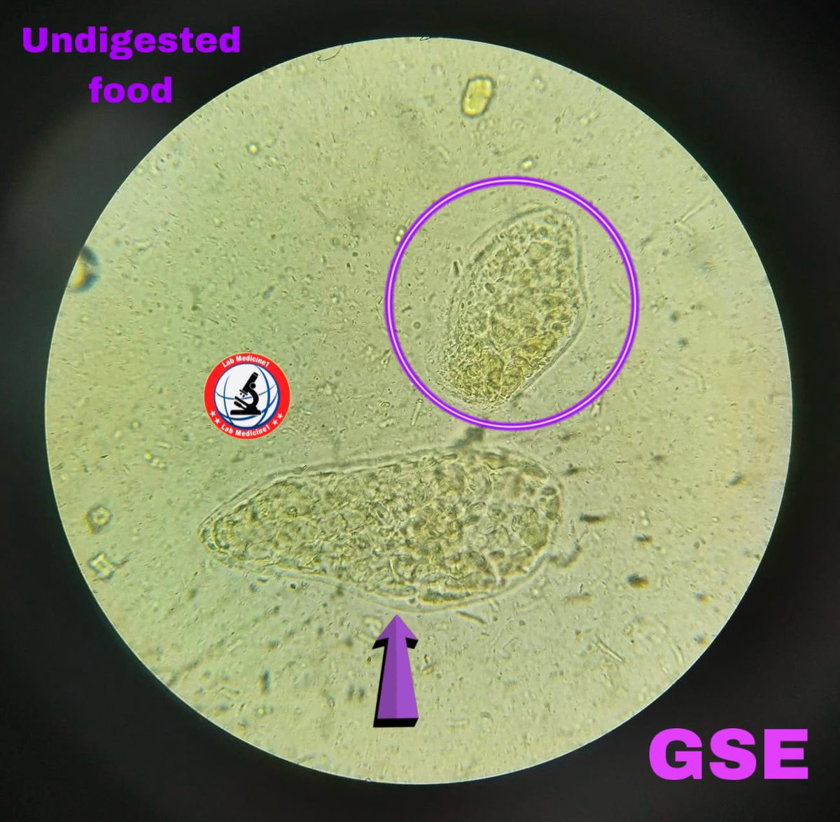 Lab_Medicine1's tweet image. #gse #GSE #undigested food youtube.com/@Lab_Medicine1