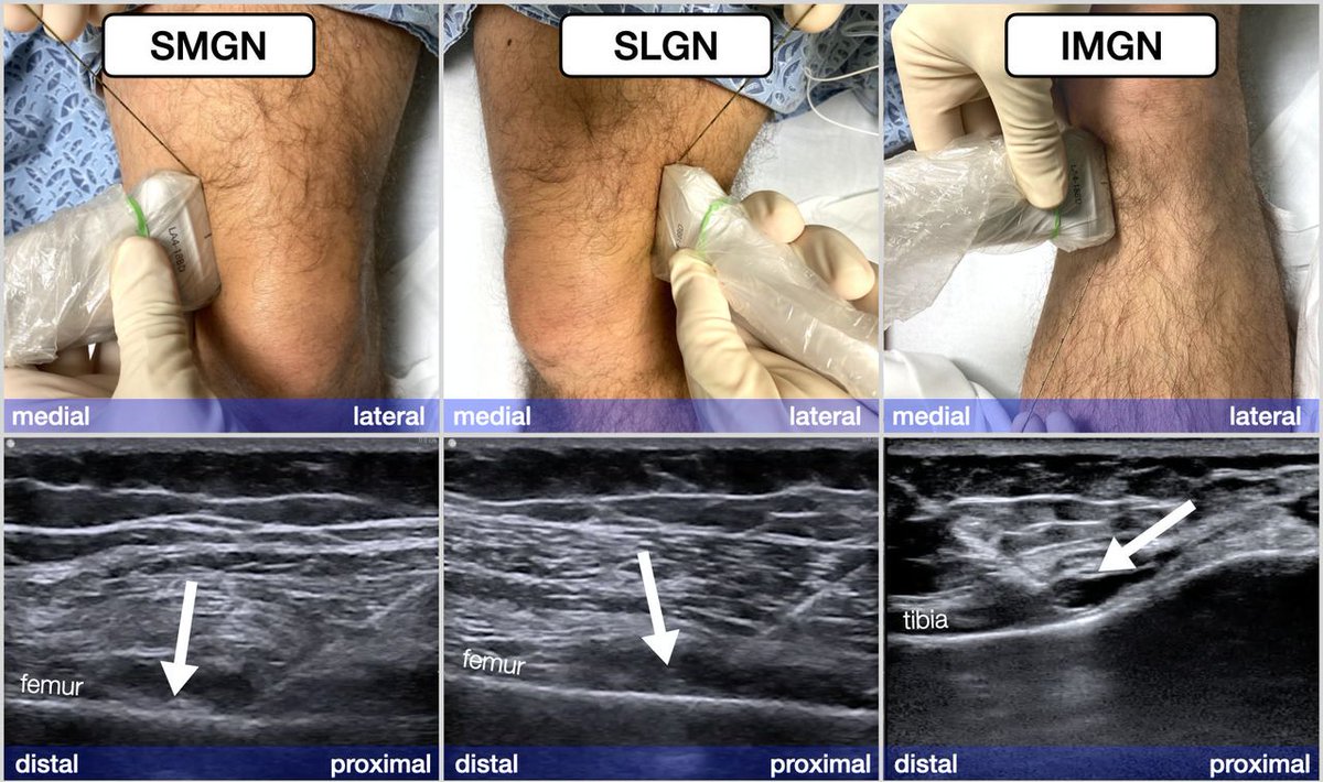 🔍 Intraoperative Genicular Nerve Blocks vs. Periarticular Infiltration for Post-Knee Surgery Pain Relief 🦵💊

A recent trial compared two techniques for pain management post-total knee arthroplasty. 🩺

Read more about this study here: bit.ly/4ajf5VS