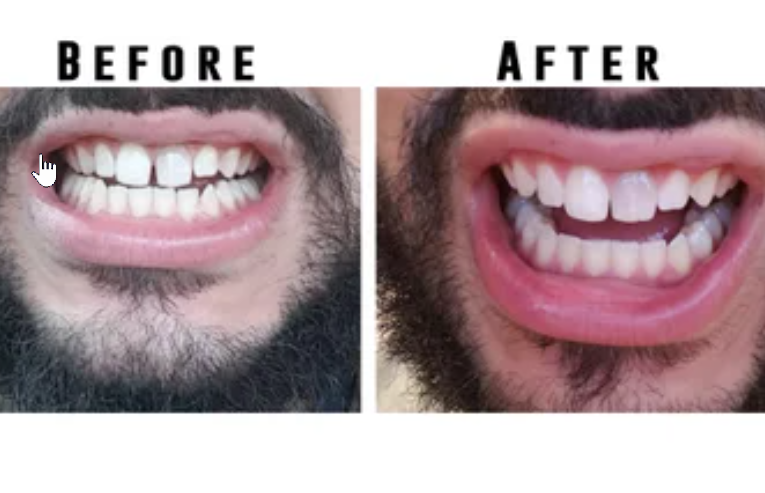 Read all of the old comments from the last decade about the now-defunct SmileDirectClub, and how it's now managing bankruptcy. 
dentalbuzz.com/2014/09/26/ski…