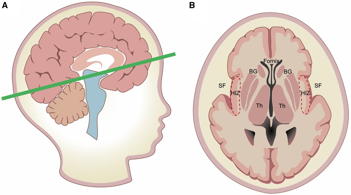 Fetal insular measurements in pregnancy with estimated fetal weight &lt;10th centile and childhood neurodevelopmental outcomes - Anatomical location of hypoechoic insular zone (HIZ) ow.ly/WcMj50QlKSX