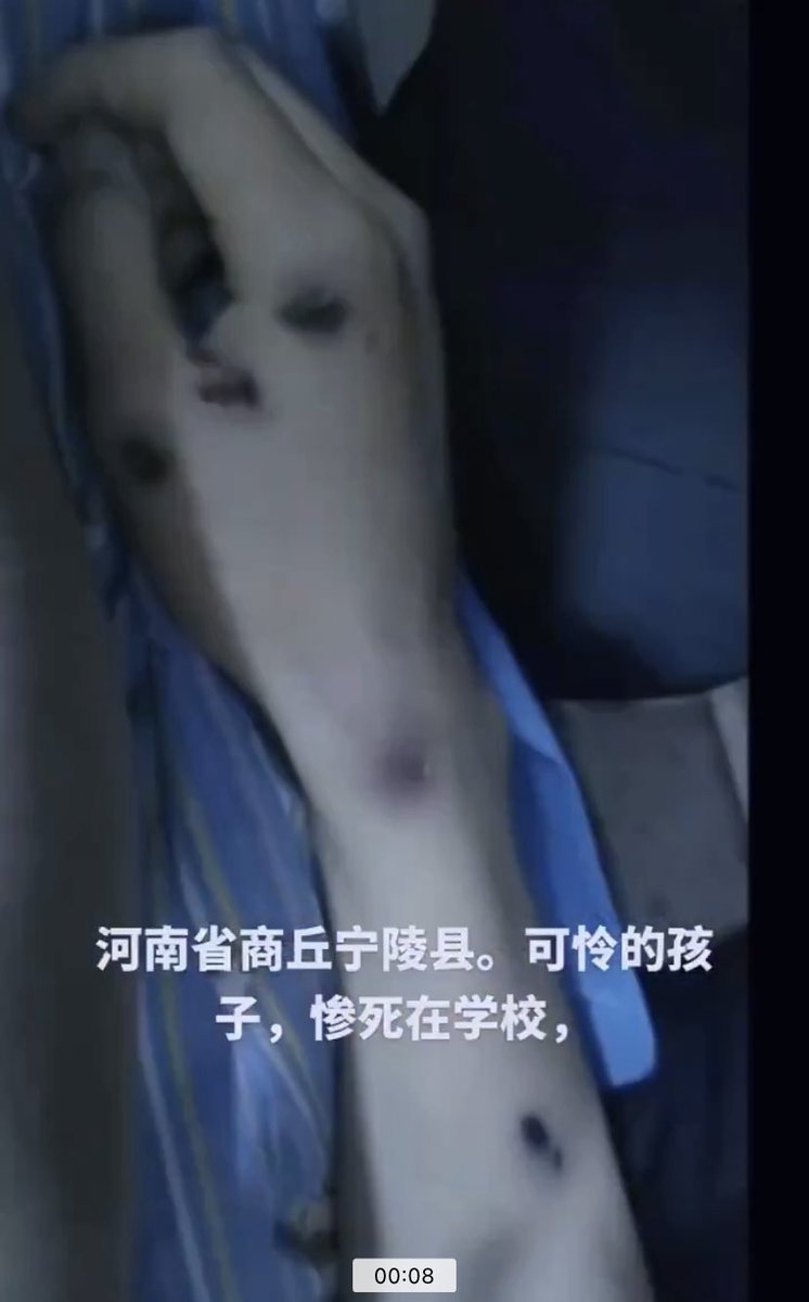 LUOXIANG_PMTQ's tweet photo. 中共国2023年12月23日，河南省宁陵县育华园高级中学一名学生坠亡。该学生浑身是伤，手上被螺丝刀贯穿，腿上青紫，伤口甚至露着骨头，学校却坚称该学生是坠楼死亡！
从该学生的伤口明显看出生前遭到了非人的折磨！
中共外交部：中国是世界上最安全的国家！ https://t.co/mK0kQttBnN