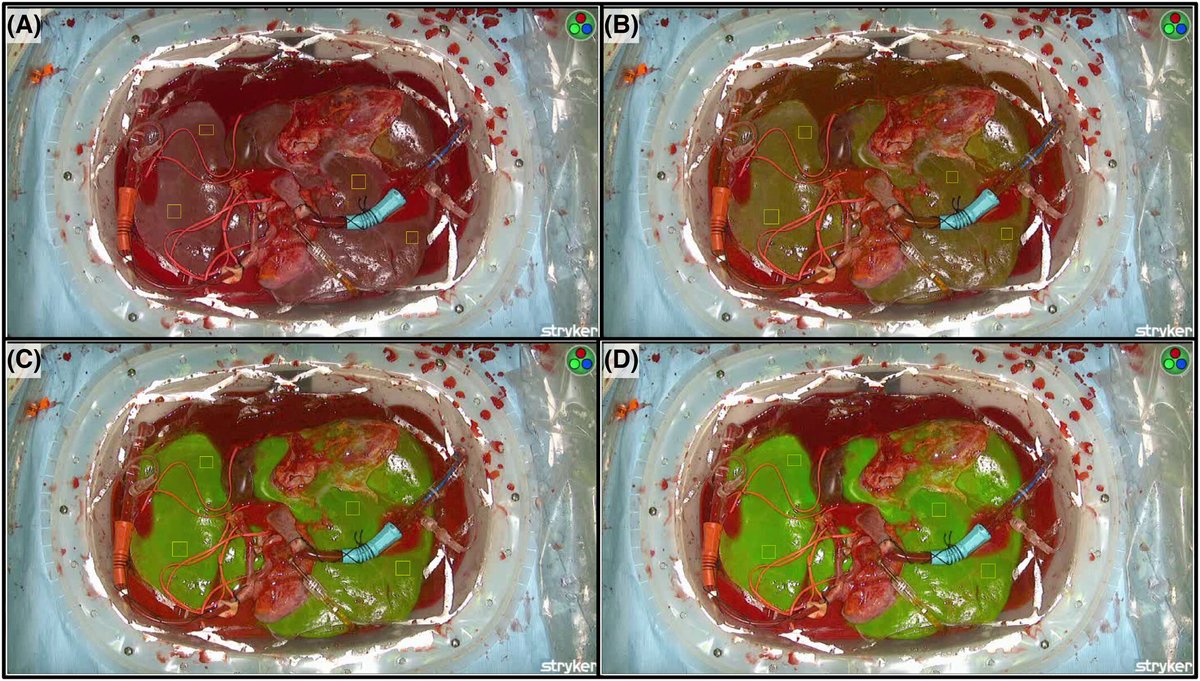 #IndocyanineGreen: A novel marker for assessment of #GraftQuality during #ExSitu normothermic machine perfusion of human #Livers
👉tinyurl.com/5n7af2ze
@Sydney_Uni🇦🇺| @Carpul1 #ViabilityAssessment