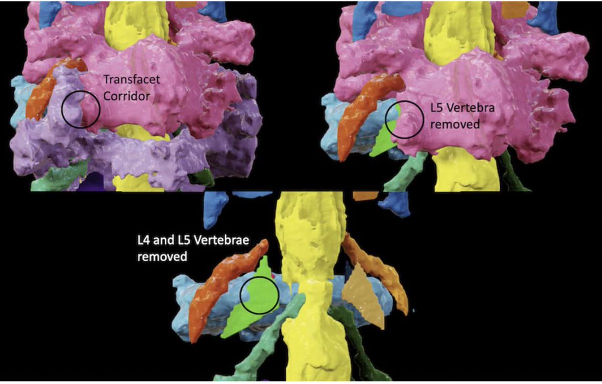 pubmed.ncbi.nlm.nih.gov/38149852/ Using Novel Segmentation Technology to Define Safe Corridors for Minimally Invasive Posterior Lumbar Fusion @QTabarestani David Salven @dawsykes Alyssa Bartlett. Mounica Paturu, Chris Dibble. Chris Shaffrey. Wilson Ray. John Chi. @walterfwiggins