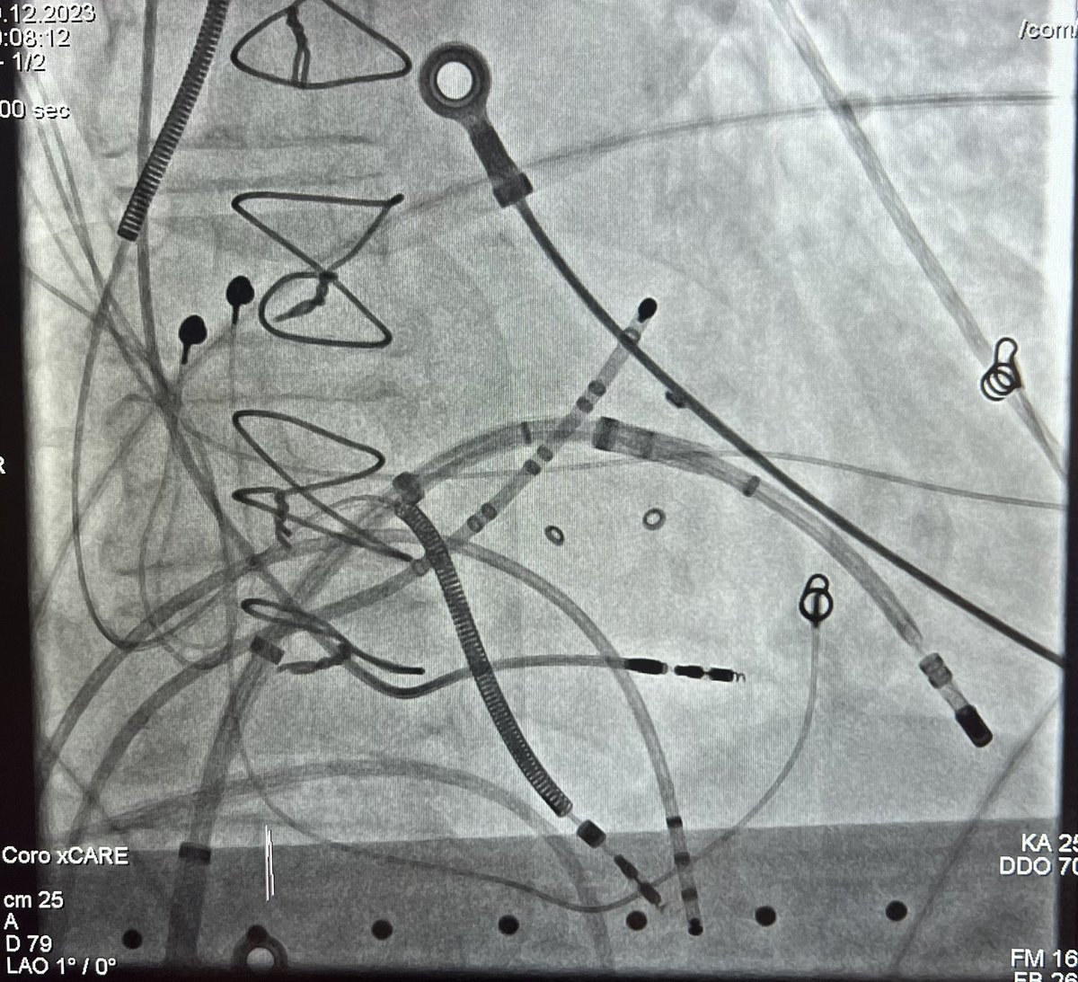 Way to end the year @ #EPSegeberg. From 8 Shocks to noninducible. S/P multiple device infections. Nice signals at the isthmus. @MartinBorlich @ChristianHeeger @sebFeickert @AlexGPott @evgeny_lyan @Phiso_de @BiosenseWebster @dr_pmueller @veramasloo @Mel_Gunawardene @AGEP_DGK