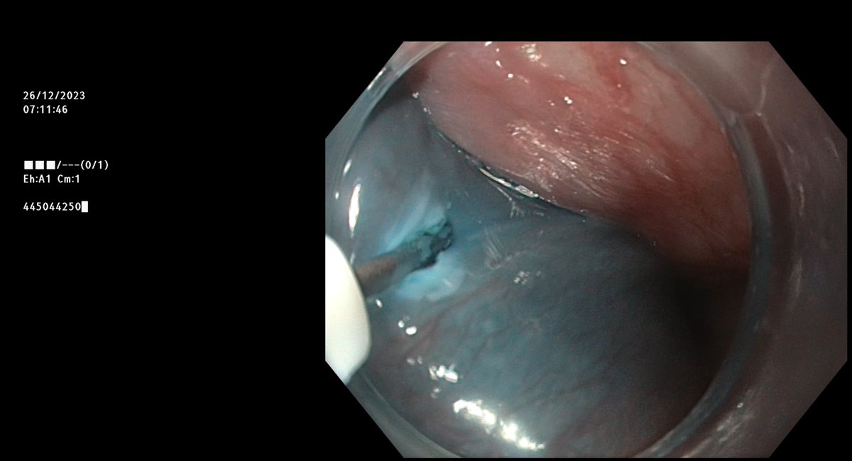 Third-space endoscopy cases : ( E-POEM, Z-POEM, and G-POEM). All needles and types of knives can do the job safely and efficiently. Please select what you prefer, the availability of needles, and finally consider their great support for your academic and educational activities.