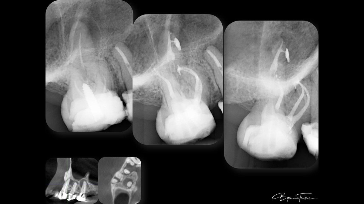 Last treatment of the year. Retreatment of 16. removal of post missed MB2 but that lateral canal palataly that was scouted and prepared as much as I could made my day. The rest well hyflex OGSF EDM. Happy new year all #rootcanal