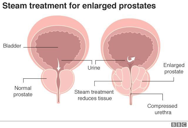 A treatment with steam -(REZUM) for Enlarged prostate &gt; buff.ly/2N58T8U &gt; I offer this treatment at the Nuffield Hospital in Derby. Call 03007906192 for an appointment #prostate #Medical #REZUM