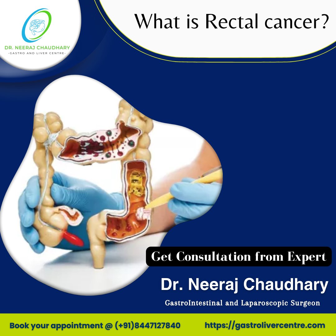 What is Rectal cancer?
Rectal cancer is a disease in which malignant (cancer) cells form in the tissues of the rectum
----
#GastroandLiverCentre #DrNeerajChaudhary #acutepancreatitis #piles #hernia #livertreatment #coloncaner #Gastriccancer #Gastritis #Symptoms #pancreaticcancer