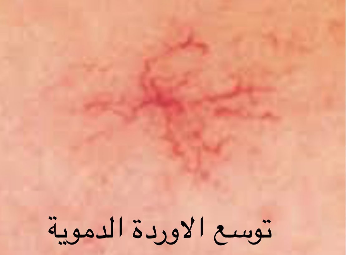 Dr_mahaalnemer's tweet photo. تغيرات طبيعية للبشرة في الحمل
 
▪️بقع بنية على الخدين والانف
▪️غمق الرقبه والابط 
▪️خط بني طولي غامق من البطن إلى الاسفل
▪️توسع الاوردة والدوالي 
▪️ترقق الجلد وحدوث علامات التمدد 
▪️زيادة شعر الوجه أو ظهور بثور

♦️السبب: 
هرمونات الحمل و زيادة هرمون الميلانين تحدث تصبغات عامه في الحمل
هذه التغيرات بعضها مؤقته وتزول بعد الولادة

♦️العلاج في الحمل:
استخدام كريمات عنايه وترطيب 
استخدام واقي الشمس وسكنيورين