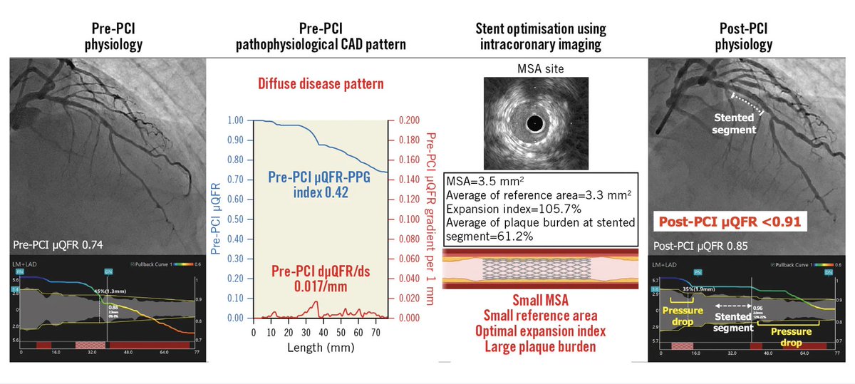Salvatore Brugaletta (@sbrugaletta) on Twitter photo A physiological diffuse pattern prePCI is an independent factor in predicting unfavourable immediate haemodynamic outcomes post-PCI, even after stent optimisation using intracoronary imaging. we need something more for these cases.any idea?eurointervention.pcronline.com/article/prepro… <a href="/EuroInterventio/">EuroIntervention</a> A physiological diffuse pattern prePCI is an independent factor in predicting unfavourable immediate haemodynamic outcomes post-PCI, even after stent optimisation using intracoronary imaging. we need something more for these cases.any idea?eurointervention.pcronline.com/article/prepro… <a href="/EuroInterventio/">EuroIntervention</a>