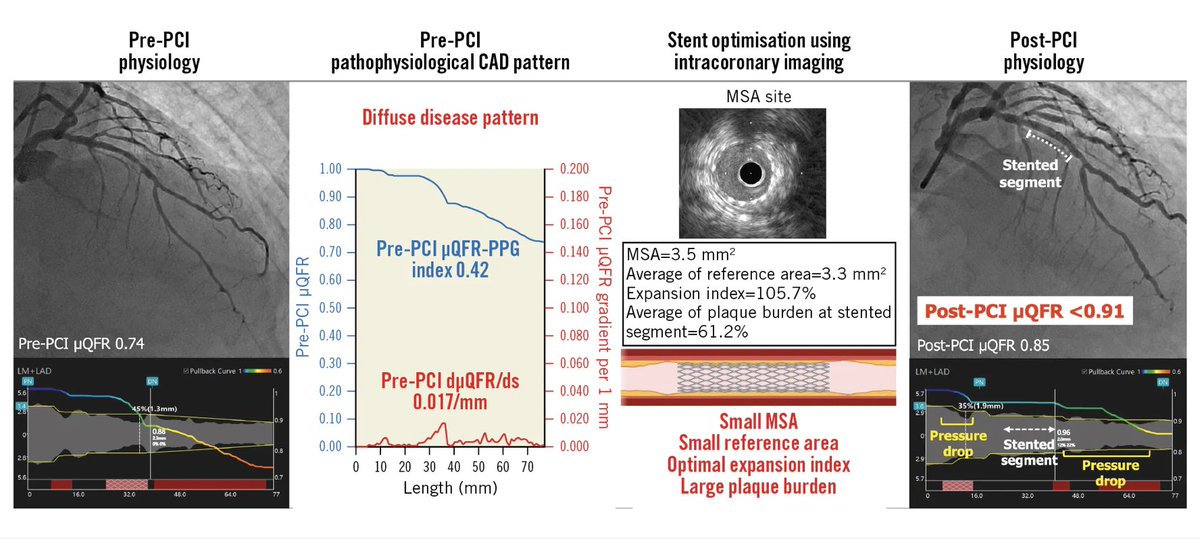 A physiological diffuse pattern prePCI is an independent factor in predicting unfavourable immediate haemodynamic outcomes post-PCI, even after stent optimisation using intracoronary imaging. we need something more for these cases.any idea?eurointervention.pcronline.com/article/prepro… @EuroInterventio