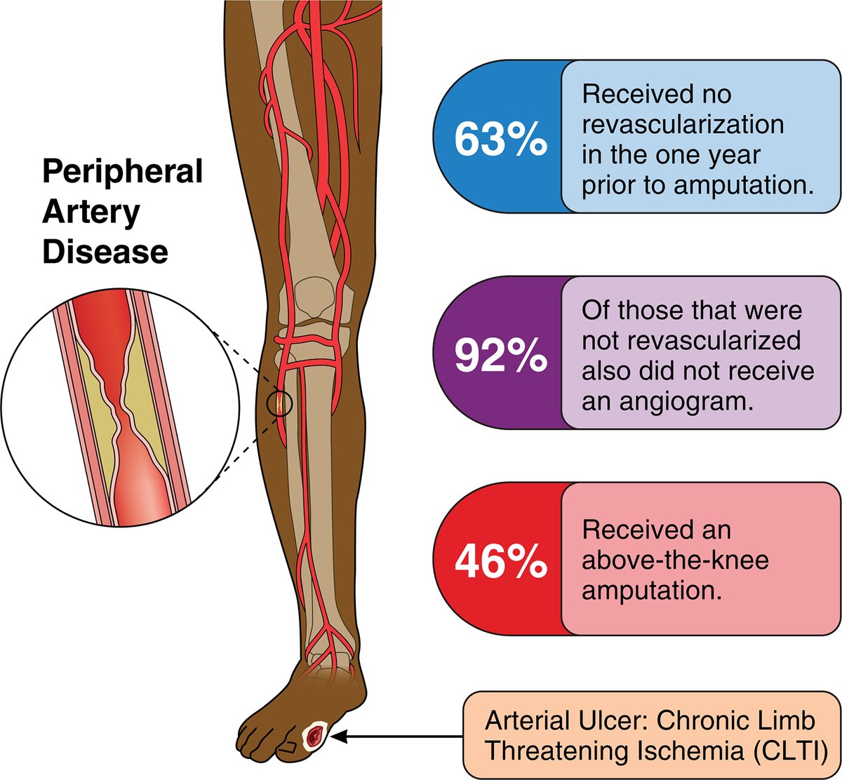 Humbling findings to end a controversial year: we continue to fail our PAD pts, esp those at greatest need.  We have to join as a vascular community, no matter speciality or site of service. Hoping for greater collaborations & bending the amp curve in '24. rb.gy/o56x09