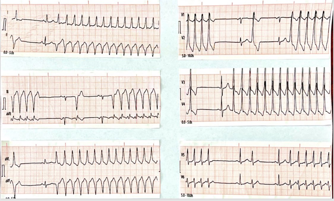 @clinica_sec 👨 de 55 años sin antecedentes de patología cardiovascular ingresa por FOD ( fiebre origen desconocido) y en sala presenta inestabilidad hemodinamica + palpitaciones … Dx: Taquicardia Ventricular 😅 Sospecha Endocarditis infecciosa