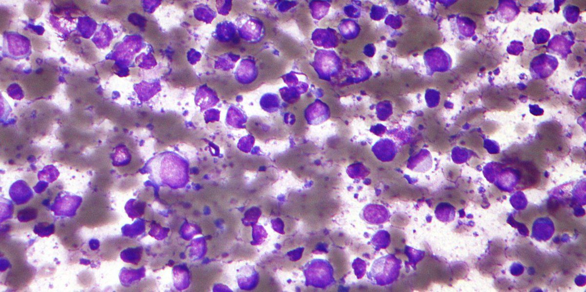 OncologyTimes's tweet photo. Transformations in diffuse large B-cell #lymphoma are extremely rare. In this article, researchers present a very rare case of #DLBCL transforming into #lymphoblasticlymphoma diagnosed by fine-needle aspiration cytology and flow cytometry. https://t.co/ocebwx1TOK https://t.co/xIcpEvxu8i