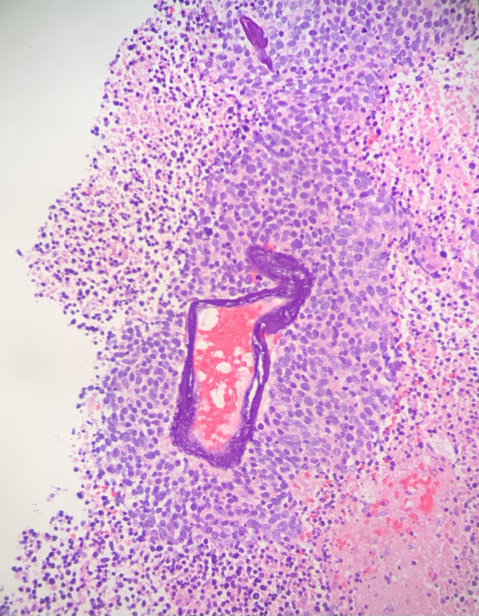 #pathology #hemepath well, the groin lymph node core wasn’t a lymphoma, but what an example of a textbook phenomenon!