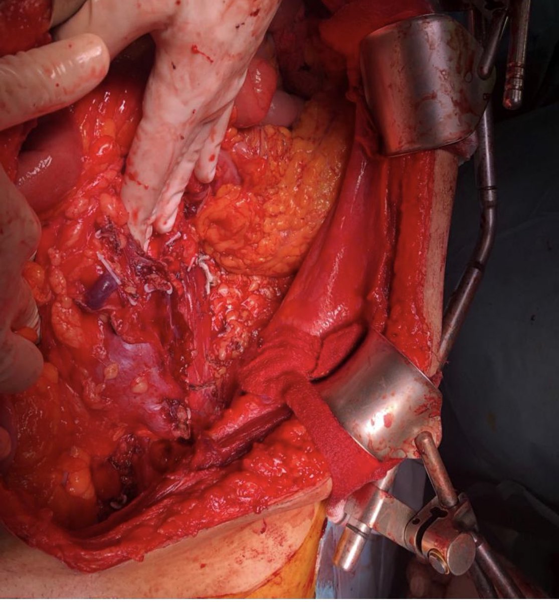 Final🔝 2023 desde el quirofano, la importancia de la cirugia retroperitoneal con dos casos derivados desde otros centros  👉tumor con trombo en cava EIII 👉 gran masa en Riñon Herradura <a href="/BarranqueroSaez/">Felipe Saez Barranquero🇪🇸</a> <a href="/RamonBonilla/">RamonBonilla</a> <a href="/JACanteroUro/">Juan Andrés Cantero</a> <a href="/pplo59/">Miguel Ángel Suárez Muñoz</a> <a href="/gemma_espi68754/">Gemma Sánchez Espín</a> <a href="/HUVV_SAS/">Hospital Clínico Virgen de la Victoria</a> <a href="/saludand/">Consejería de Salud y Consumo</a>