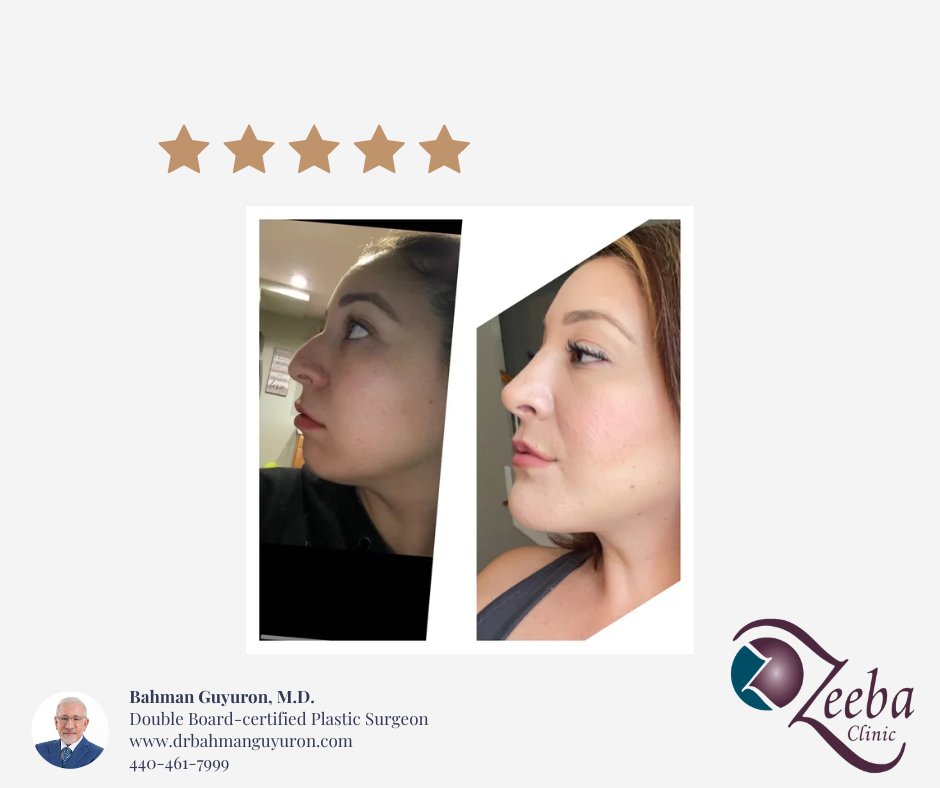 Our thrilled patient, Stephanie, shares her stunning before and after photos following her nose and chin surgeries performed by Dr.Guyuron. If you are curious about making a change in the new year, contact Zeeba Clinic for a consultation at 440-461-7999.