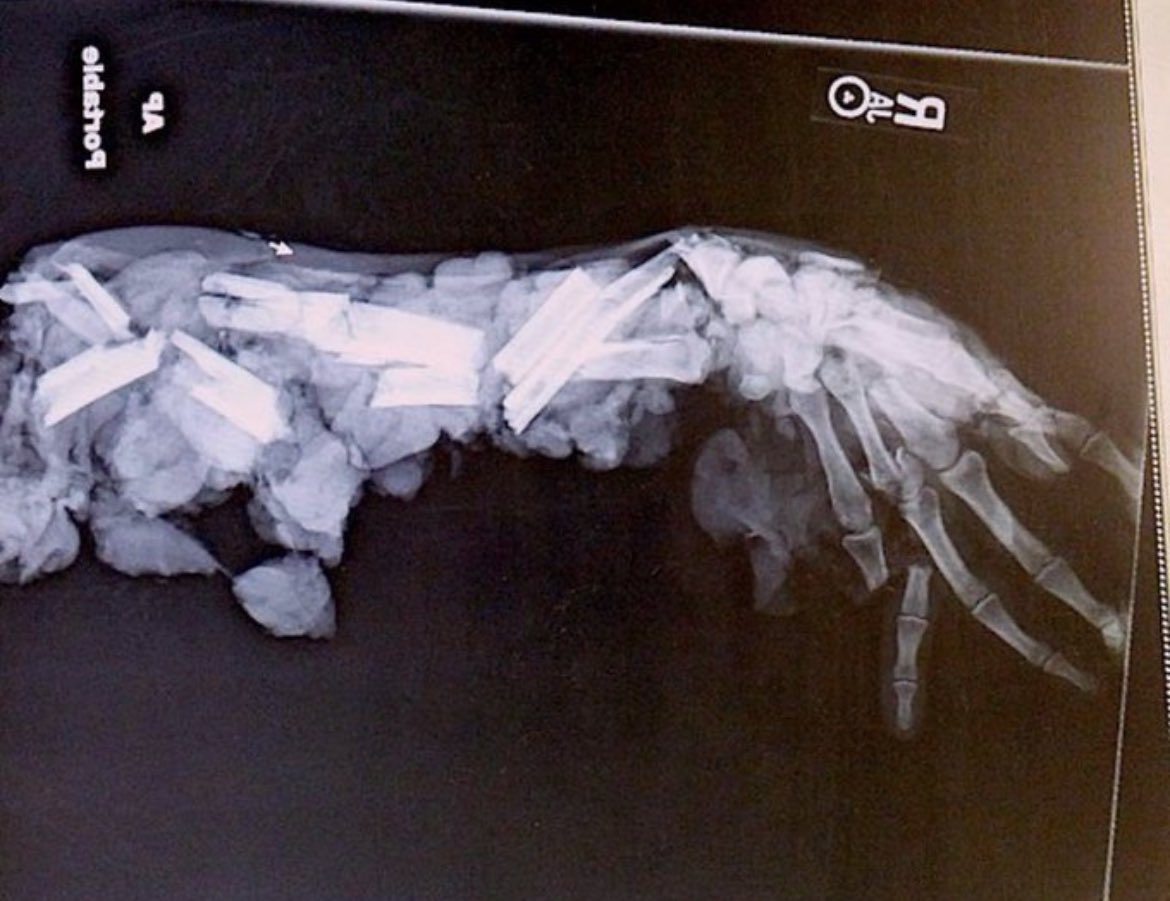 MorbidKnowledge's tweet photo. Harrowing X-ray of a mans arm and
hand after a horrific meat grinder
accident. https://t.co/Jp8PS35KpM