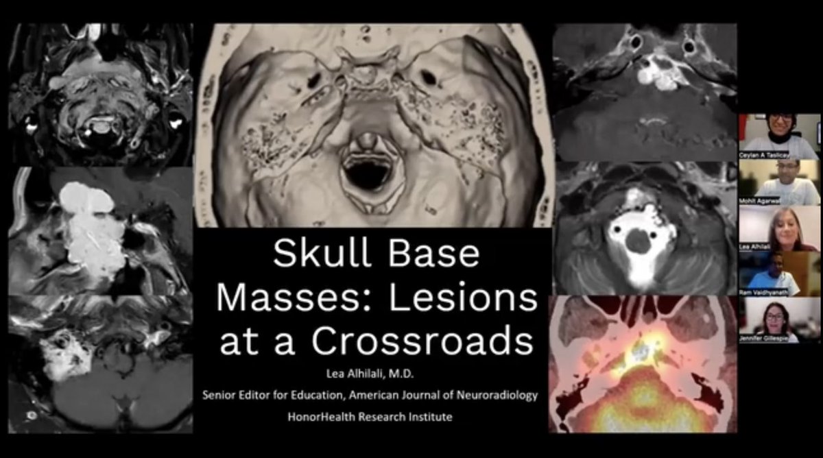 The Cortex Club (@thecortexclub) on Twitter photo The much awaited recording of <a href="/teachplaygrub/">Lea Alhilali, MD</a> session on Skull Base Tumors is here ! LINK : thecortexclub.org/webinars/skull… The much awaited recording of <a href="/teachplaygrub/">Lea Alhilali, MD</a> session on Skull Base Tumors is here ! LINK : thecortexclub.org/webinars/skull…