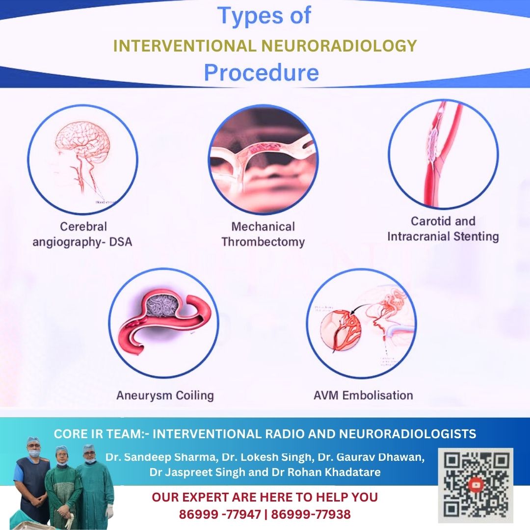 Know the different types of Interventional Neurology procedures. To Know More or Book an appointment reach out to us through a call or WhatsApp message at +91 86999-77947. . #neurointerventional #interventionalNeurology #neurologist #doctor #interventionalneurologist