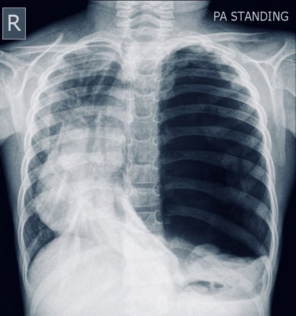Patient presents with severe dyspnea after chest injury.

Diagnosis ?