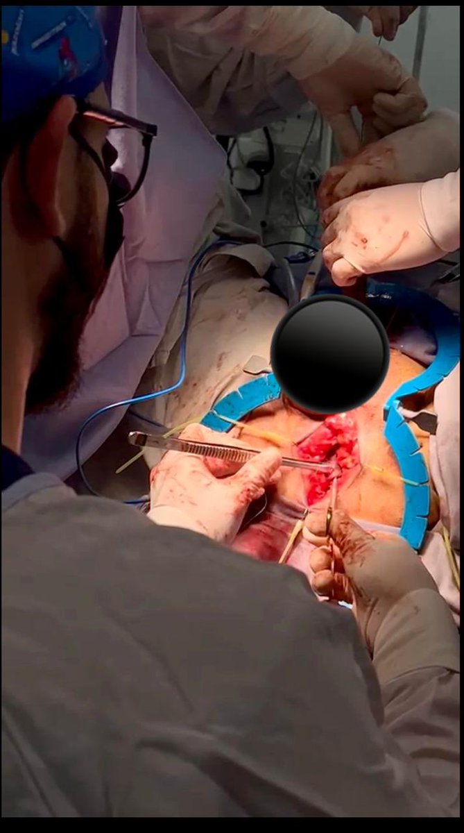 62 años posqx RTUP se realizó plastia con BMG, colocamos dos injertos sin contratiempos. <a href="/Aldolsterona/">Dr. Almeida</a>