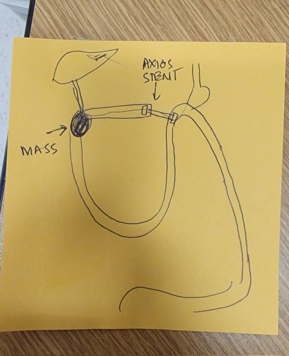 Muhammad Arslan Baig (@muhammadbaigmd) on Twitter photo EDEE to decompress malignant HJ obstruction due to tumor recurrence post whipple. Same session ercp was performed due to acute cholangitis.
<a href="/BilalMohammadMD/">Mohammad Bilal, MD</a> <a href="/drdhaliwal85/">Amaninder Dhaliwal</a> <a href="/RobertoSimonsMD/">Roberto Simons-Linares, MD</a> <a href="/SaqibWalayat/">Saqib Walayat</a> <a href="/SultanMahmoodMD/">Sultan Mahmood MD</a> <a href="/EndoscopyOthman/">Mohamed Othman</a> <a href="/MetabolicEndo/">Chris Thompson, MD</a> <a href="/ChahalPrabhleen/">Prabhleen Chahal MD,MASGE,FACG</a> <a href="/docdhir/">vinay dhir</a> EDEE to decompress malignant HJ obstruction due to tumor recurrence post whipple. Same session ercp was performed due to acute cholangitis.
<a href="/BilalMohammadMD/">Mohammad Bilal, MD</a> <a href="/drdhaliwal85/">Amaninder Dhaliwal</a> <a href="/RobertoSimonsMD/">Roberto Simons-Linares, MD</a> <a href="/SaqibWalayat/">Saqib Walayat</a> <a href="/SultanMahmoodMD/">Sultan Mahmood MD</a> <a href="/EndoscopyOthman/">Mohamed Othman</a> <a href="/MetabolicEndo/">Chris Thompson, MD</a> <a href="/ChahalPrabhleen/">Prabhleen Chahal MD,MASGE,FACG</a> <a href="/docdhir/">vinay dhir</a>