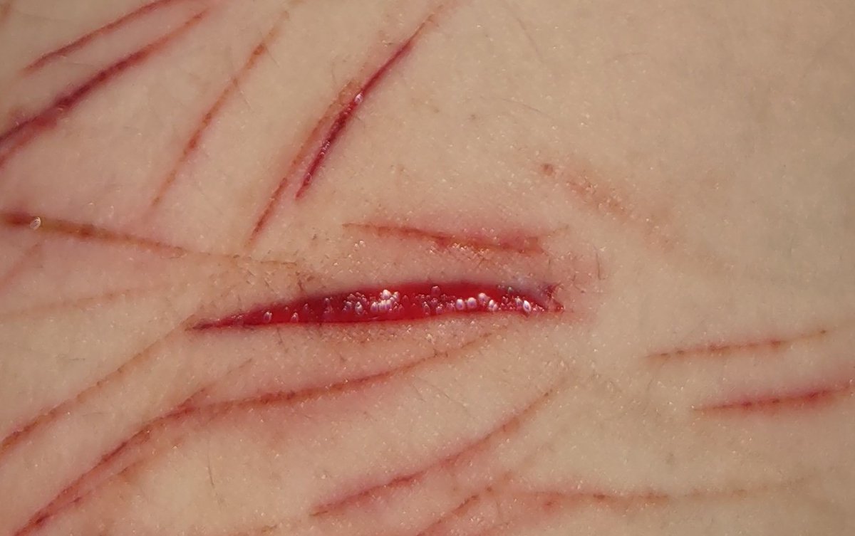 starvingscemo's tweet photo. i woke up this morning hungover and covered in blood. i am not getting that drunk again but i got a nice cut https://t.co/OqaWygMrGW
