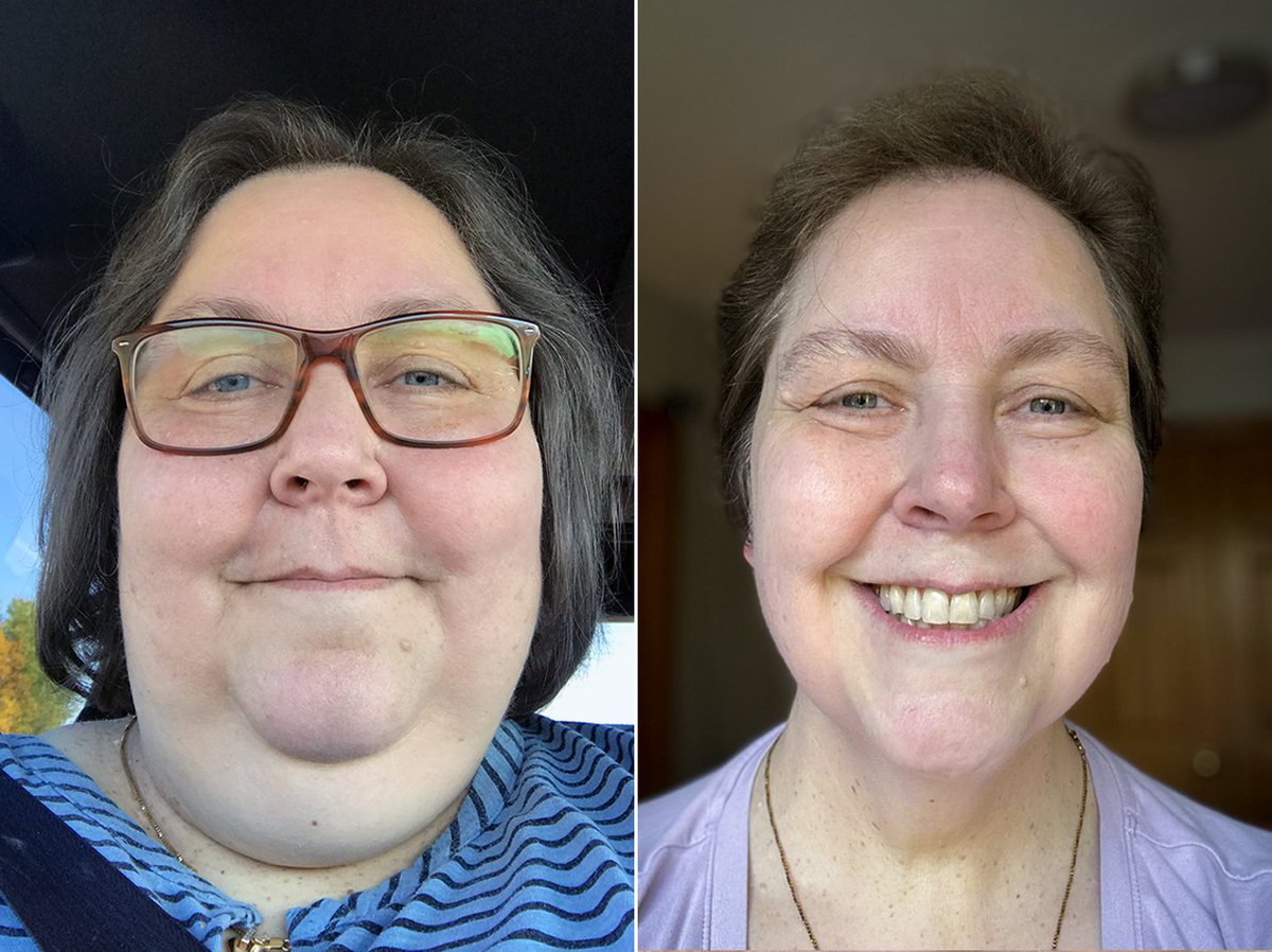 REV_Insulin_Res's tweet photo. Listening to the health segment on the news yet again, I was informed that consuming red meat leads to obesity, a statement supposedly supported by a study of 67,000 individuals over many years. What nonsense.
Eating meat-based keto saved my life.
Now, four years into my health journey, I continue to ponder why a ketovore diet is allegedly not sustainable long-term and why eliminating certain foods seems to inevitably result in binging on them. Perhaps in my fifth year, I'll finally understand.
#properHumanDiet #cleanKetovore #avoidSugarAndGrains