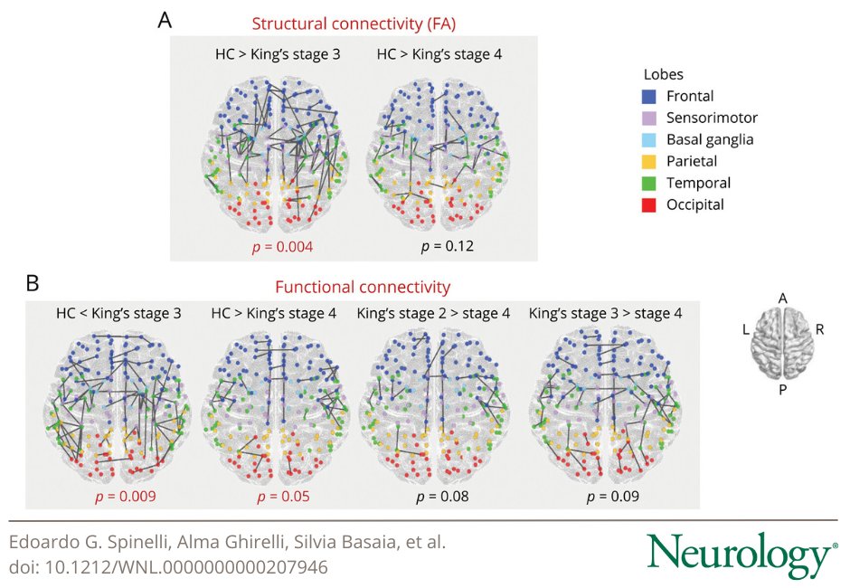 GreenJournal's tweet photo. Structural and Functional Brain Network Connectivity at Different King's Stages in Patients With Amyotrophic Lateral Sclerosis: https://t.co/j9fJeZij53

#NeuroTwitter #ALS https://t.co/fpFLRke56e