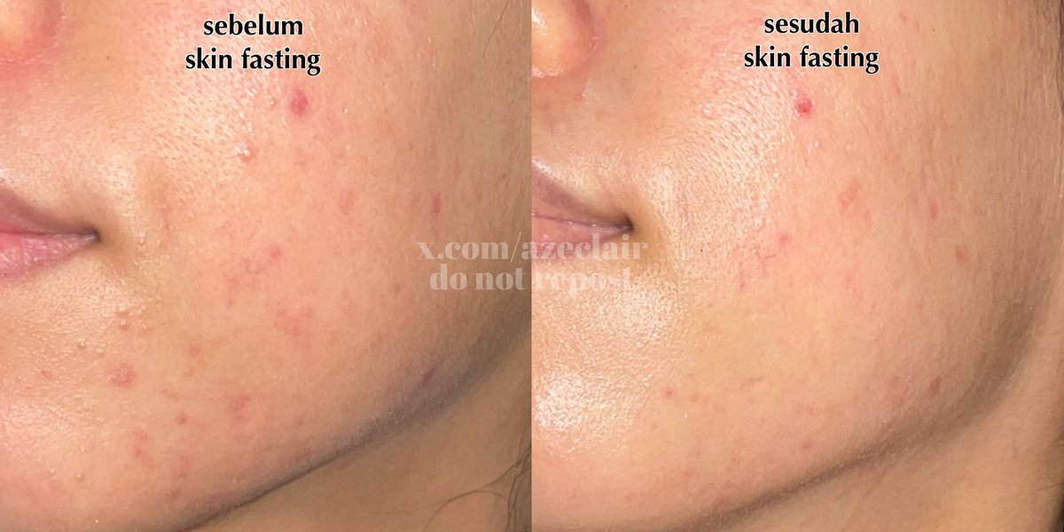azeclair's tweet image. jalan 2 bulan konsisten nerapin skincare pake metode “skin fasting” dan begini hasilnya🥹

“Skin Fasting itu apa sih?”